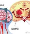 人為什么會得腦溢血