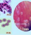 尖銳濕疣是hpv16還是18