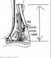 跟腱長度怎么量。
