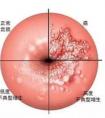 HPV和TCT之間的區(qū)別？