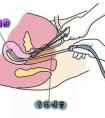 怎么區(qū)分刮宮和清宮