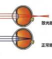 近視與遠視的區(qū)別？